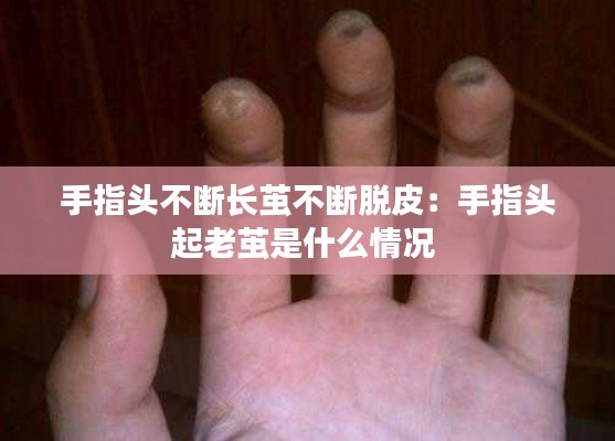 手指头不断长茧不断脱皮：手指头起老茧是什么情况 