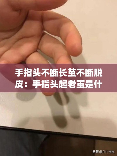 手指头不断长茧不断脱皮:手指头起老茧是什么情况