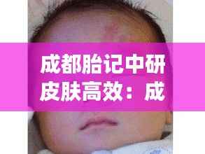 成都胎记中研皮肤高效：成都胎记医院 