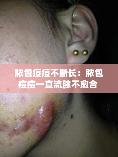 脓包痘痘不断长:脓包痘痘一直流脓不愈合