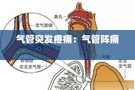 气管突发疼痛:气管阵痛