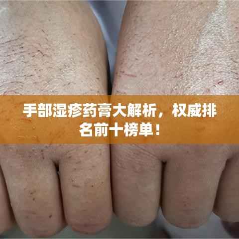 手部湿疹药膏大解析,权威排名前十榜单!