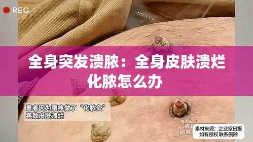 全身突发溃脓:全身皮肤溃烂化脓怎么办