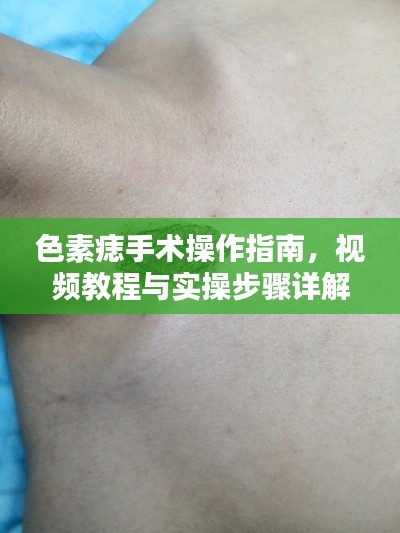 色素痣手术操作指南,视频教程与实操步骤详解
